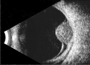 Accutome by Keeler B-Scan PLUS - bon Optic - Partner auf Augenhöhe