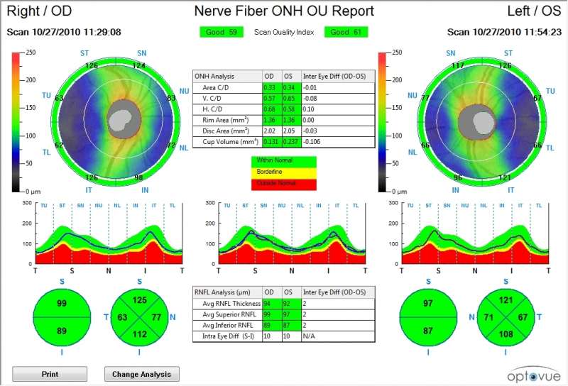 Optovue iVue 80 - Das High-Speed Praxis-OCT - bon Optic - Partner auf ...